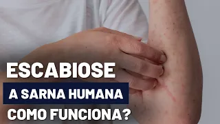 ESCABIOSE, A SARNA HUMANA, ENTENDA COMO FUNCIONA!