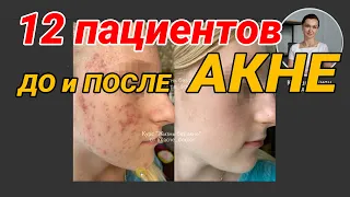 12 пациентов с  АКНЕ.  До и После - полный обзор