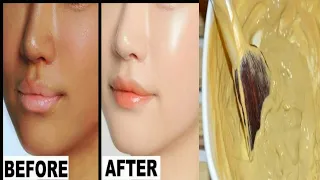 तव्चा बहुत ही ज्यादा गोरी हो जाती है मुल्तानी मिट्टी में ये मिलाकर लगाने से। skin whitening treatmen