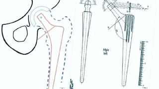 Step-by-Step Approach to templating in Total Hip Replacement