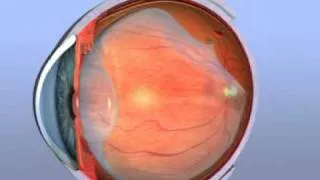 Retinal Hole