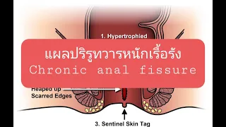 แผลปริรูทวารหนักเรื้อรัง Chronic anal fissure