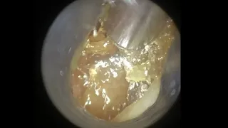 106 - Fully Blocked Sticky Ear Wax Removal with WAXscope®️