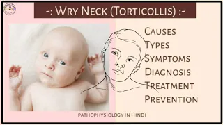 गर्दन का टेढापन | What is WryNeck or Torticollis causes, treatment | pathophysiology in Hindi.