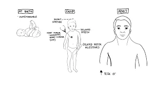 Noonan Syndrome a genetic condition