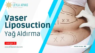 Yağ Aldırma | Vaser Liposuction (Liposakşın) Ameliyatı | Op. Dr. Leyla ARVAS #VaserLiposuction