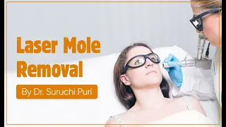Mole Removal Surgery by Laser at Dr Suruchi Puri's Clinic | Delhi | Watch the Procedure