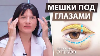 Как убрать мешки под глазами ( отеки / круги / синяки )