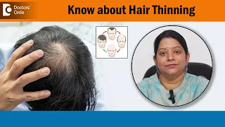 How to Know If You're Going Bald?|Thinning Hair|Androgenetic Alopecia-Dr.Vani Yepuri|Doctors' Circle