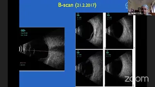 AIOC2021-GP78-Topic-Dr.Mudit Tyagi-Uveitis masquerades