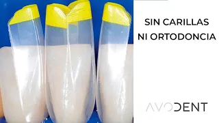 Cómo corregir dientes separados sin ortodoncia ni carillas y en una sola cita - Matrices Bioclear