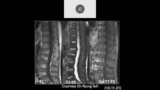 MRI of the Lumbar Spine | Part 6 - Lumbar Inflammation