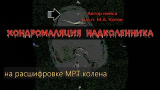 ХОНДРОМАЛЯЦИЯ НАДКОЛЕННИКА 4 степени на расшифровке МРТ коленного сустава