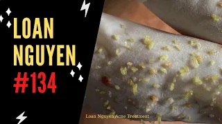blackheads extraction on the face of man (134) | Loan Nguyen