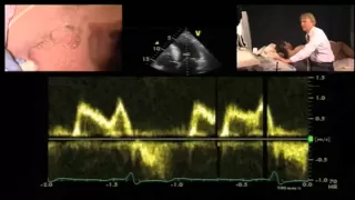 Diastolic Function — A Simple Approach