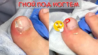 Pus under the nail 😮 Ingrown toenail