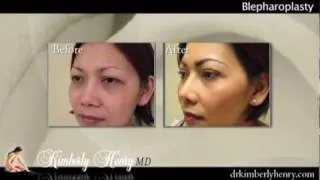 Blepharoplasty (Eyelid Surgery) in San Francisco Bay Area