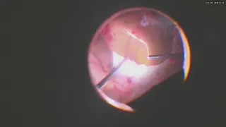 Surgery: Eckardt Keratoprosthesis and Repair of the Retinal Detachment