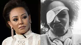 Sad News, Mel B Made Heartbreaking Confession About Going Blind In 1 Eye.