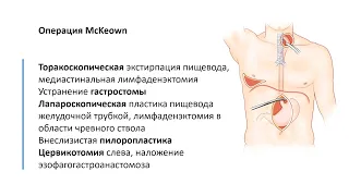 Торако-лапароскопическая операция McKeown