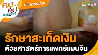 รักษาสะเก็ดเงินด้วยศาสตร์การแพทย์แผนจีน | ปรับก่อนป่วย