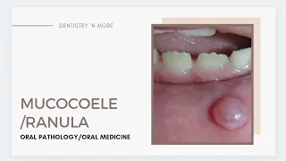 MUCOCELE/RANULA