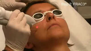 FOTONA 4D   Non invasive laser face lifting