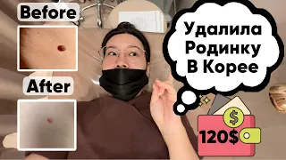 Удалила родинку в Корее. Лазерная эпиляция.