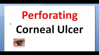 Ophthalmology 114 b Perforating Corneal Ulcer Cornea causes treatment