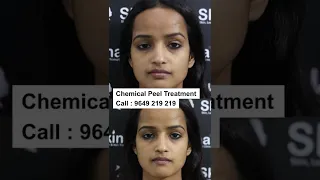 Best Chemical Peel Treatment at Skinaa Clinic | Viral #shorts