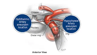 Episode 1: First Case - Large Ophthalmic Artery Aneurysm Clipping with Suction Decompression