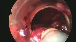 Endoscopic hematoma evacuation