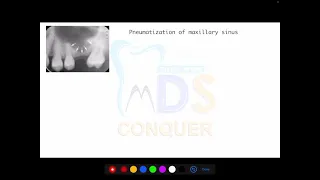 PNEUMATIZATION OF MAXILLARY SINUS || MDS CONQUER || NEET MDS || INICET MDS || ORAL SURGERY