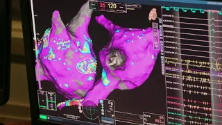 Ablation of Persistent Atrial Fibrillation Guided by Non-Invasive Mapping