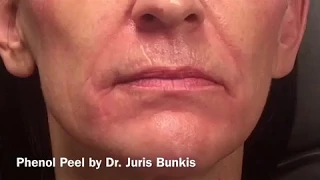 Phenol Peel -Skin Resurfacing - Dr. Juris Bunkis