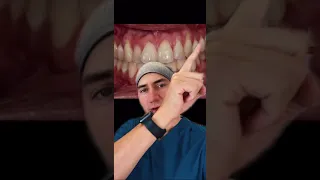 Le querían poner resina para cubrir el cuello de sus dientes. ¡Mala idea! #shorts