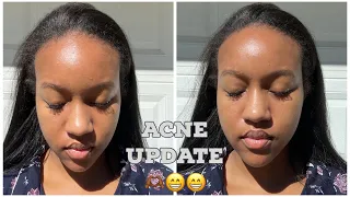Perioral Dermatitis and Hormonal Acne Update! 9 months using Dapsone Gel and Tretinoin + Acne Tips