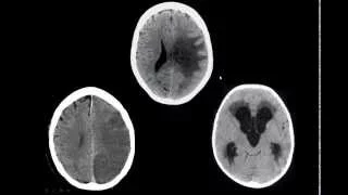 Edema cerebral vasogênico na TC