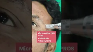 Microneedling Procedure at VCare | Best Treatment For Acne, Acne Scars, Wrinkles & Fine Lines