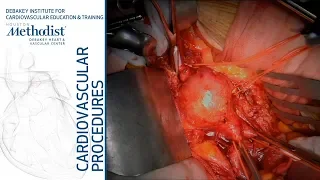 Open Abdominal Aortic Aneurysm AAA Repair (Maham Rahimi, MD & Travis Vowels, MD)