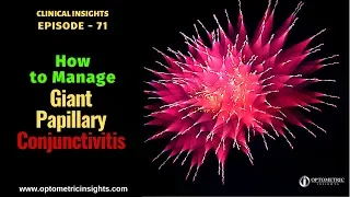 How to Manage Giant Papillary Conjunctivitis - Episode 71