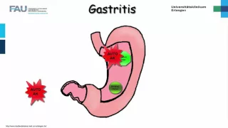 Innere Medizin ─ Gastritis