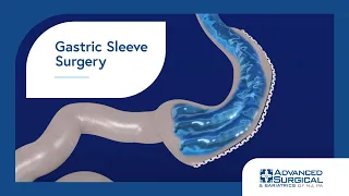 Gastric Sleeve Surgery