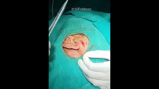 sebaceous cyst,preauricular region,face.dr jalil mujawar