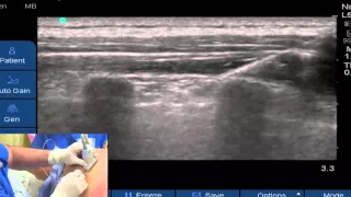 Pajunk   Tuohy Sono   Demonstration Video Paravertebral blockade