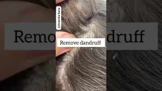 💯Remove Dandruff Just In 1 Wash🔥#dandruff #haircare #hairfall #hairgrowth #viral #1m #short #shorts