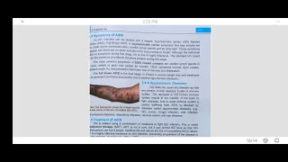 Symptoms of AIDS I Oppurtunistic Diseases I Treatment of AIDS