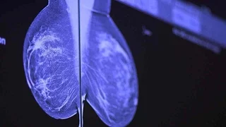 How To Catch Breast Cancer Early: Stanford Doctors Explain Mammography Options