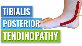 How to Get Rid of Posterior Tibial Tendonitis