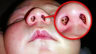 Mutter bemerkt mysteriöse Punkte in Nase des Babys. Dann finden Ärzte eine seltsame Ursache!
